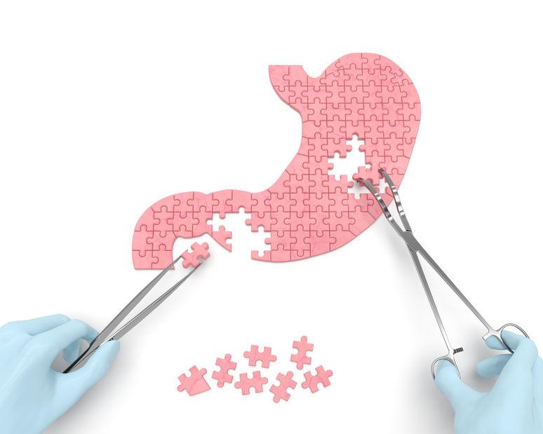 cirurgia bariátrica