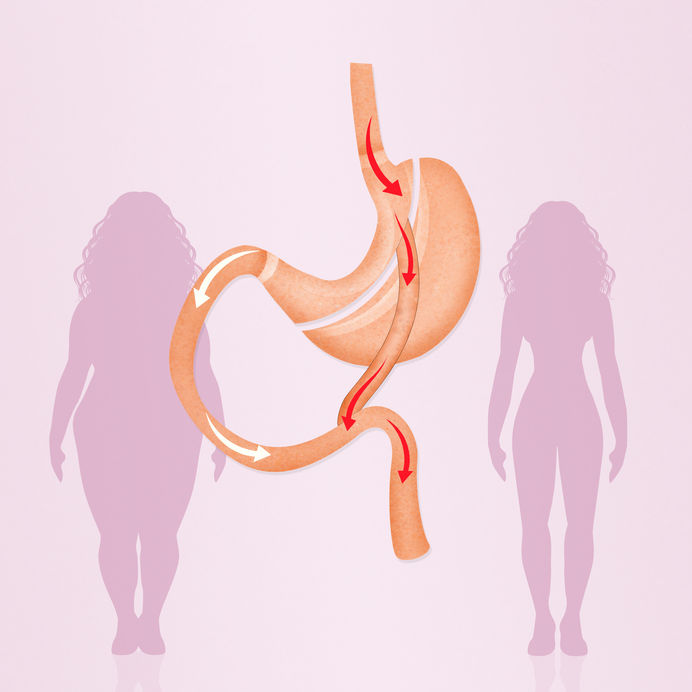 cirurgia bariátrica