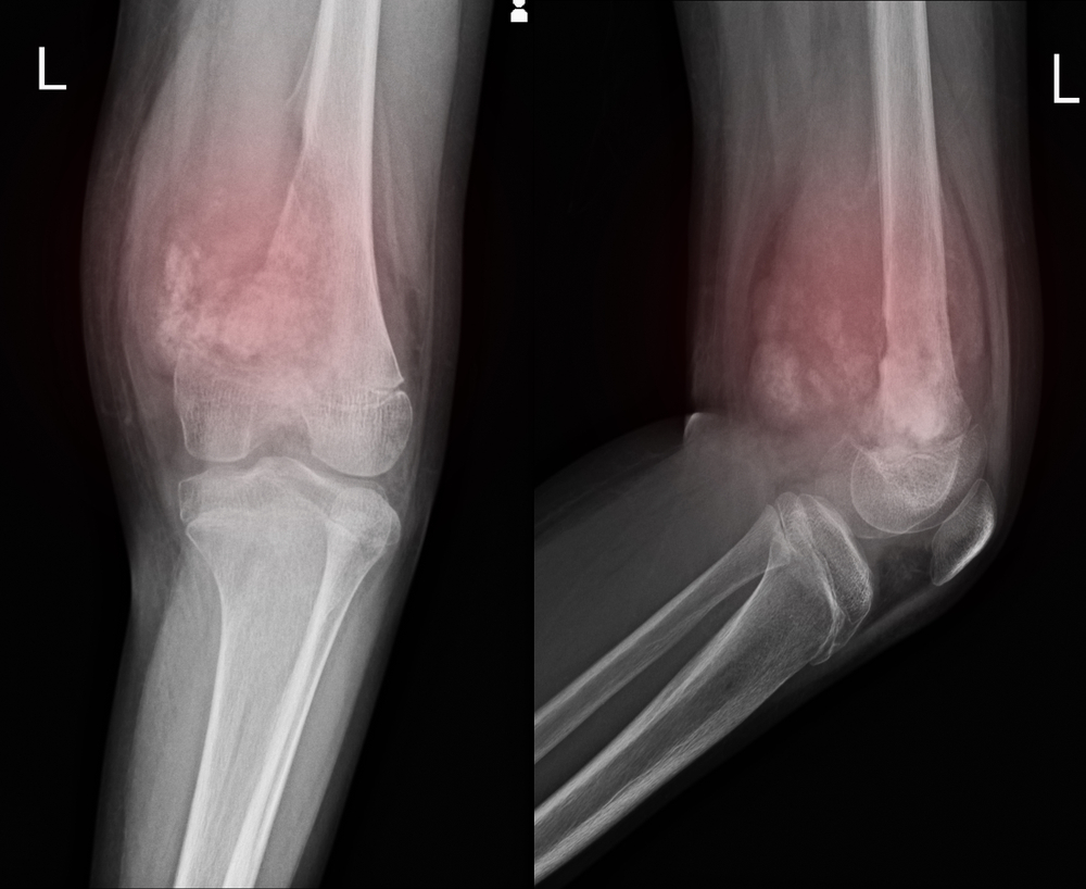 osteosarcoma