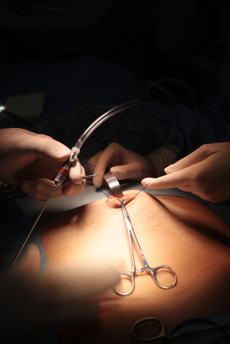 cirurgia bariátrica
