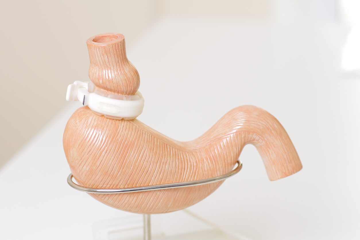 cirurgia bariátrica