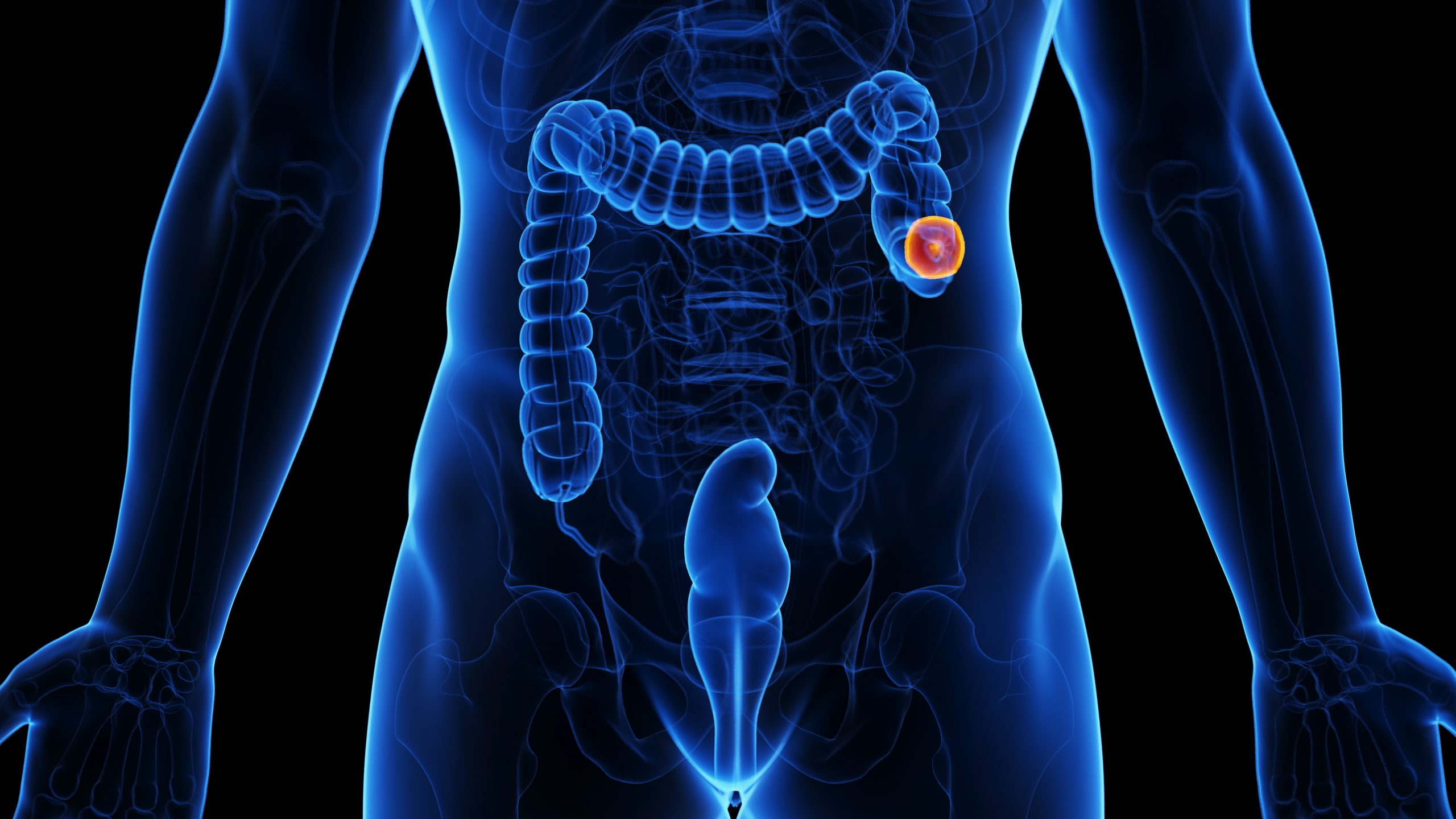 colectomia