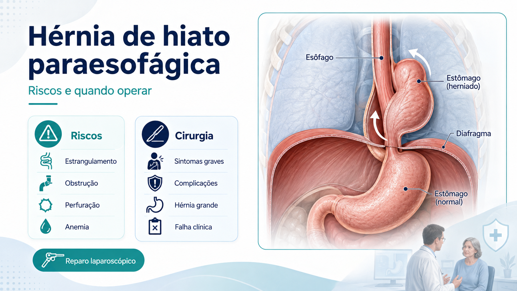 Ilustração de hérnia de hiato paraesofágica