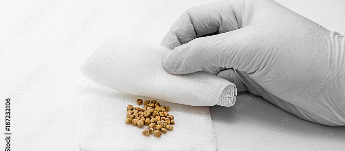 5 Sinais Que Podem Indicar Pedra Na Vesícula