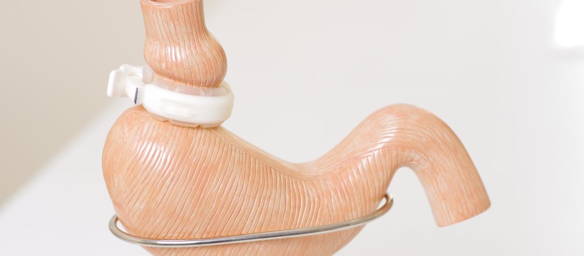 cirurgia bariátrica