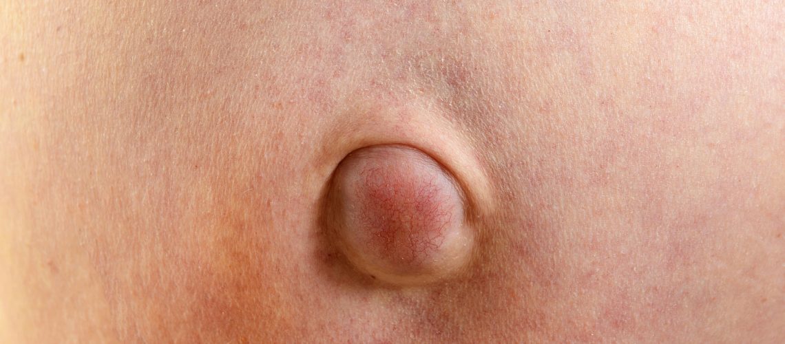 hernia-umbilical-min