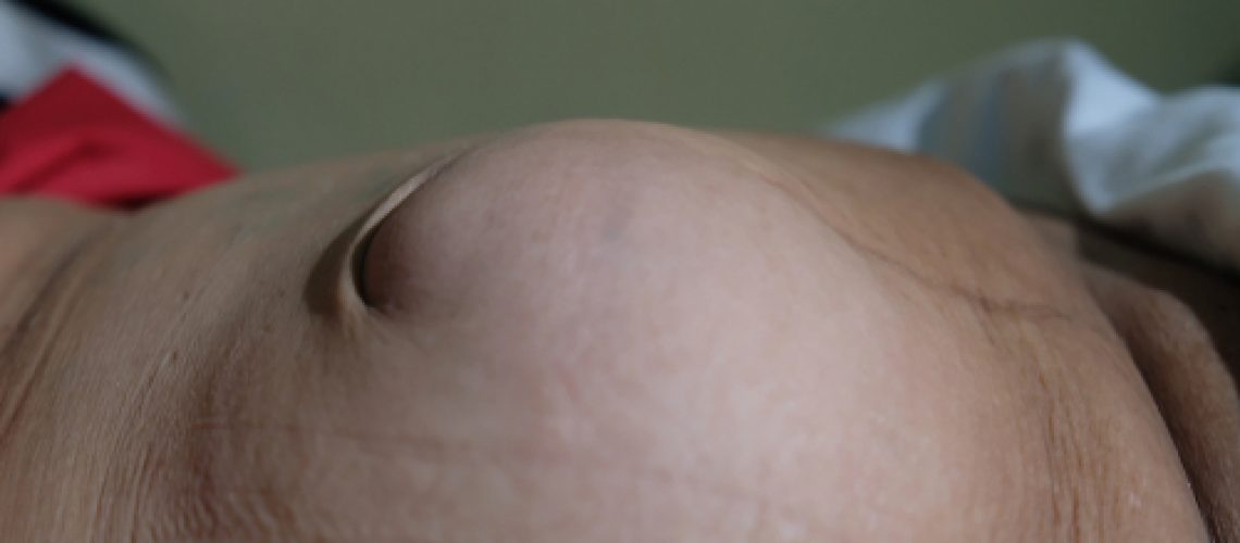 hérnia incisional