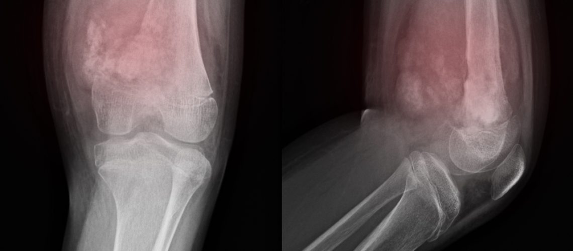 osteosarcoma