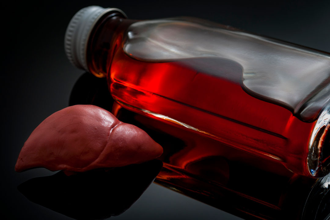 O que é gordura no fígado? Entenda as causas da esteatose hepática