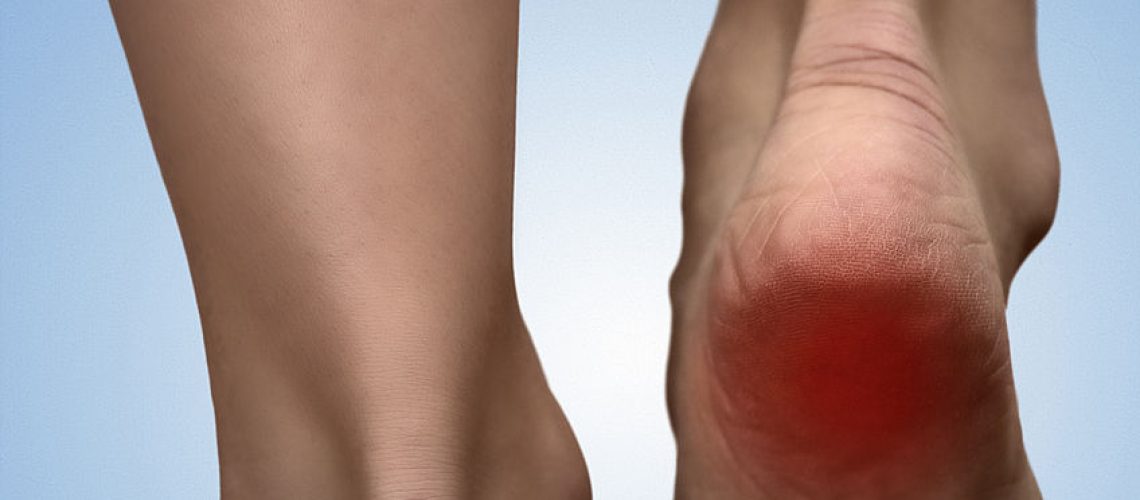 45715316 - painful heel with red spot on woman's foot. arthritis. sole spur concept. heel pain in women. pain concept