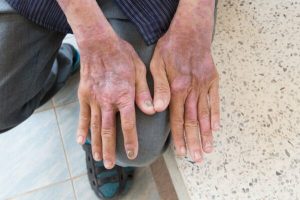 esclerodermia