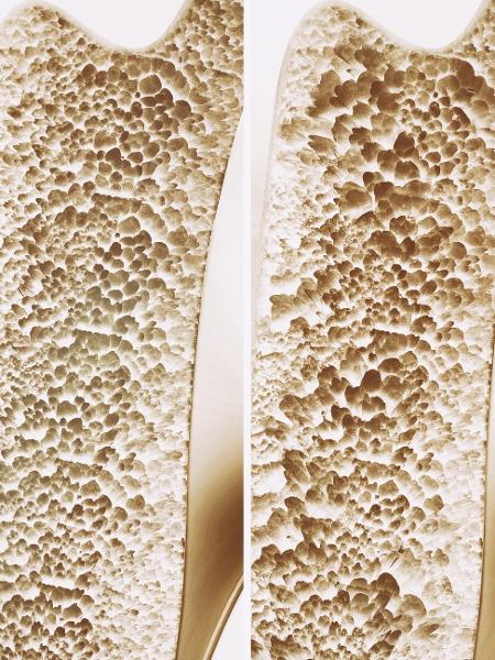 osteoporose