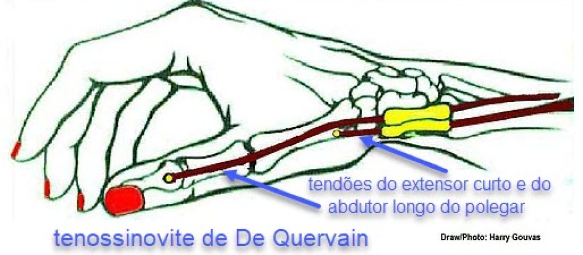 De_Quervain