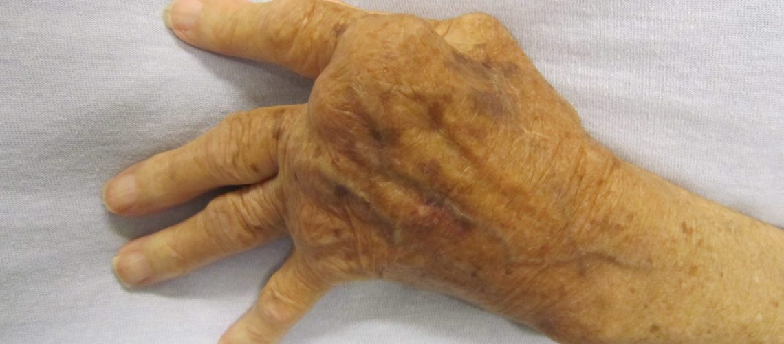 artrite reumatoide