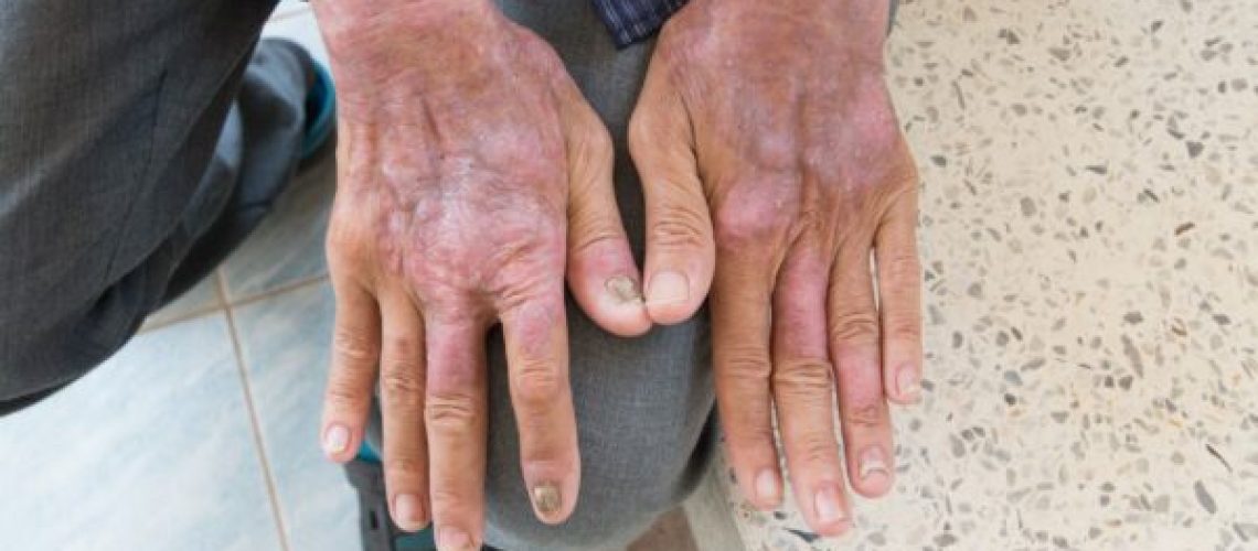 esclerodermia